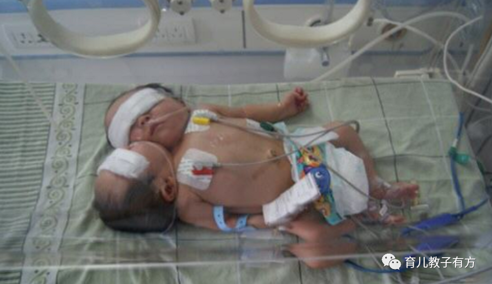 2011年四川产妇诞下中国首例“双头女婴”，后将产检医院告上公堂